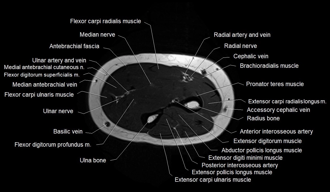 MRI 3T forearm axial cross sectional anatomy image 25.webp
